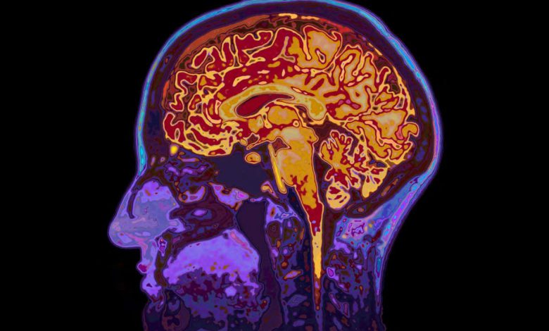 MRI برای اولین بار برای تشخیص تغییرات اپی ژنتیکی در مغز استفاده شد