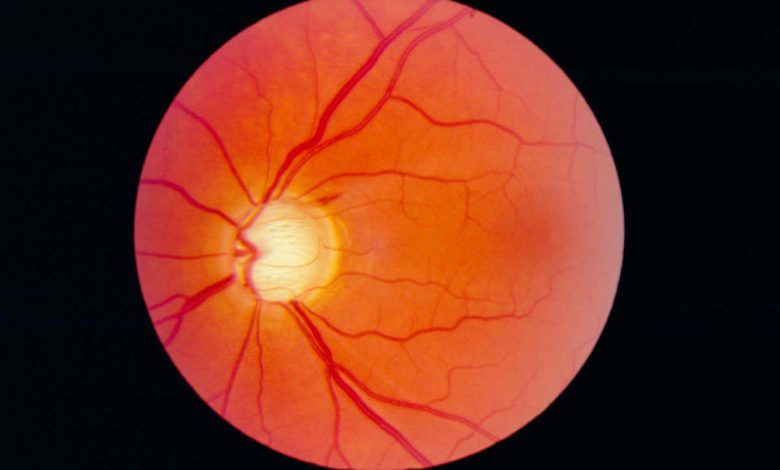 لنزهای تماسی هوشمند می توانند گلوکوم را کنترل کنند و در صورت نیاز دارو بدهند